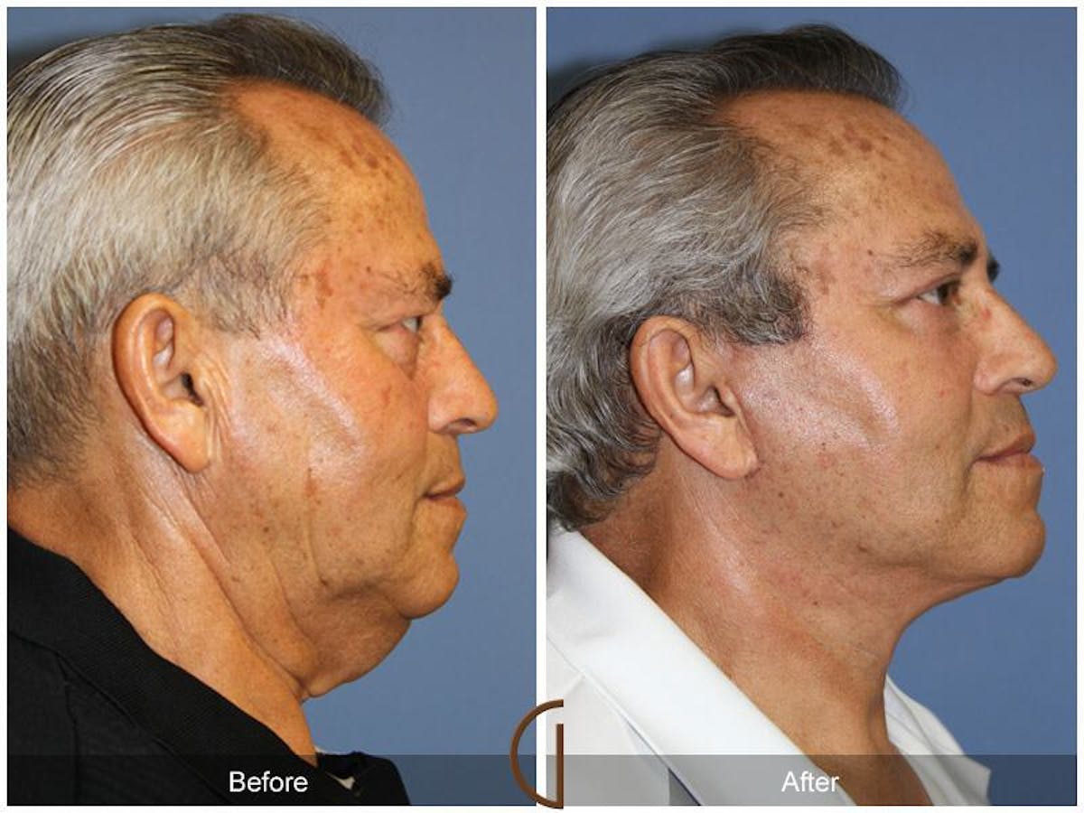 Facelift Male Before & After Gallery - Patient 205240 - Image 3