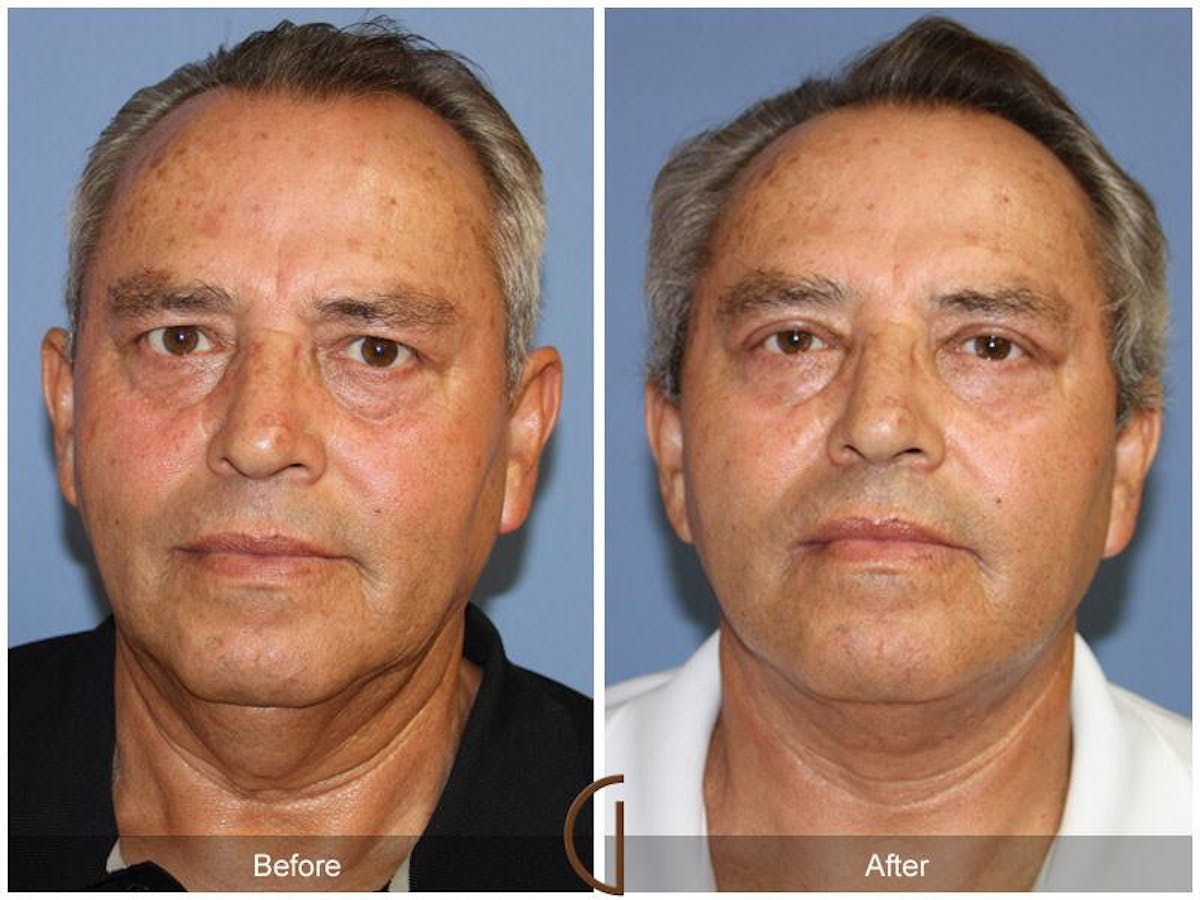 Facelift Male Before & After Gallery - Patient 205240 - Image 1