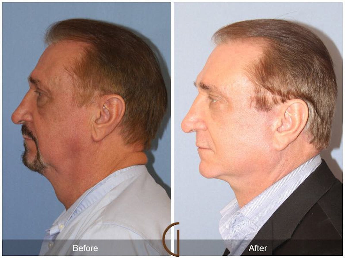 Facelift Male Before & After Gallery - Patient 173259 - Image 2