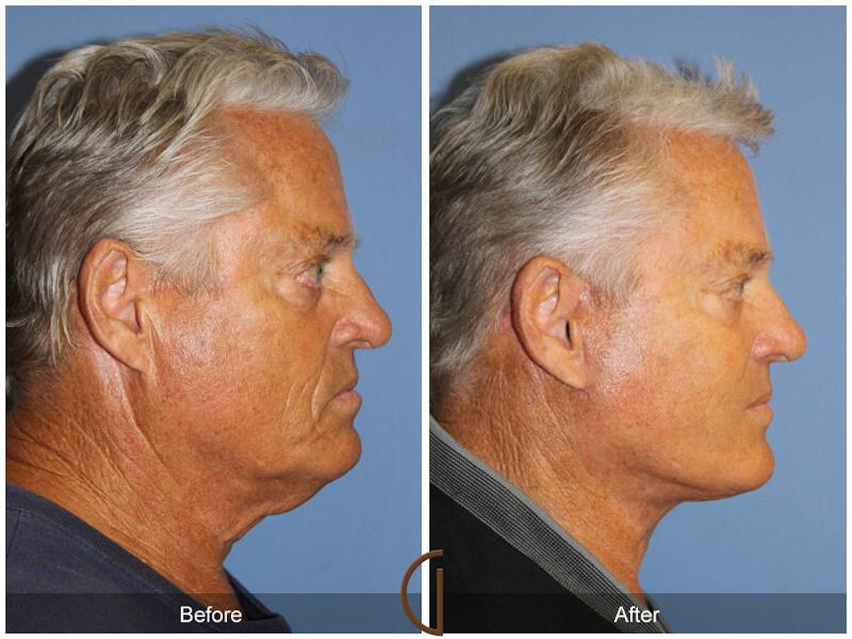 Facelift Male Before & After Gallery - Patient 229825 - Image 3