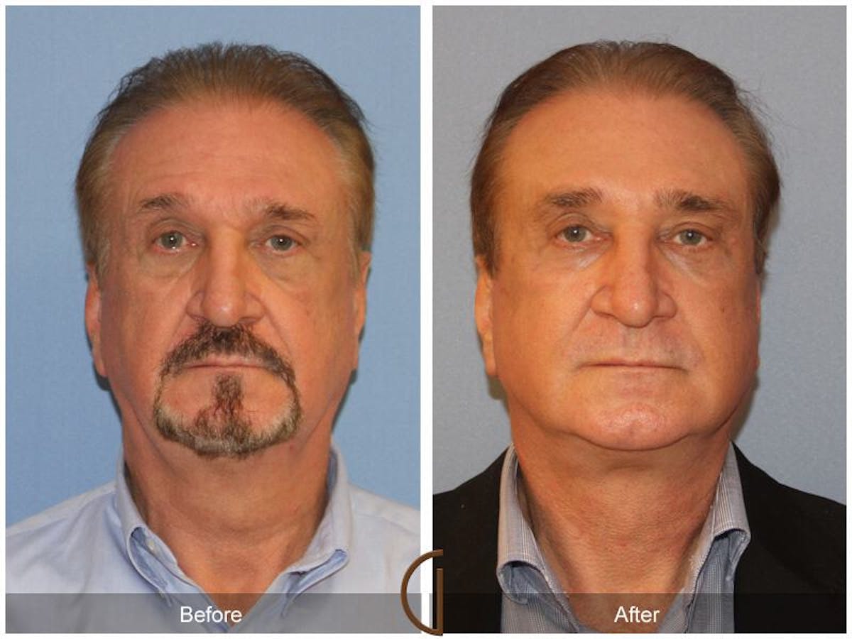 Facelift Male Before & After Gallery - Patient 173259 - Image 1