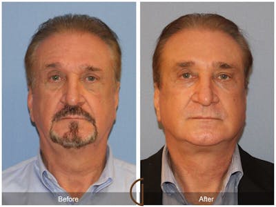 Facelift Male Before & After Gallery - Patient 173259 - Image 1