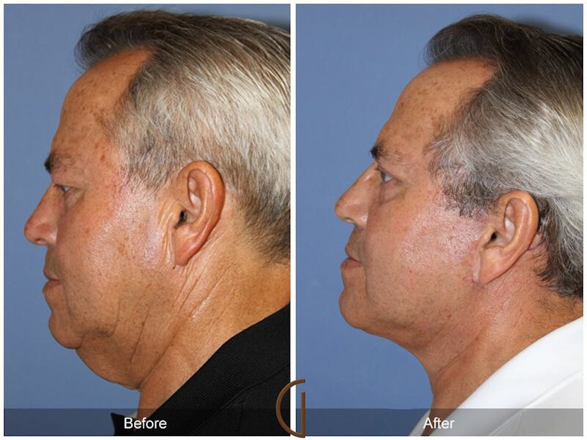 Facelift Male Before & After Gallery - Patient 205240 - Image 2
