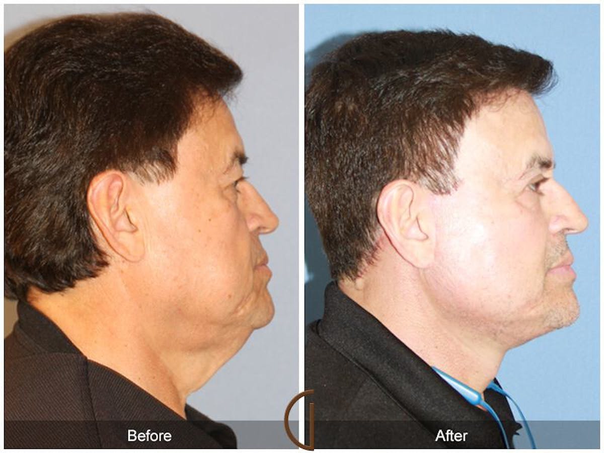 Facelift Male Before & After Gallery - Patient 304037 - Image 3