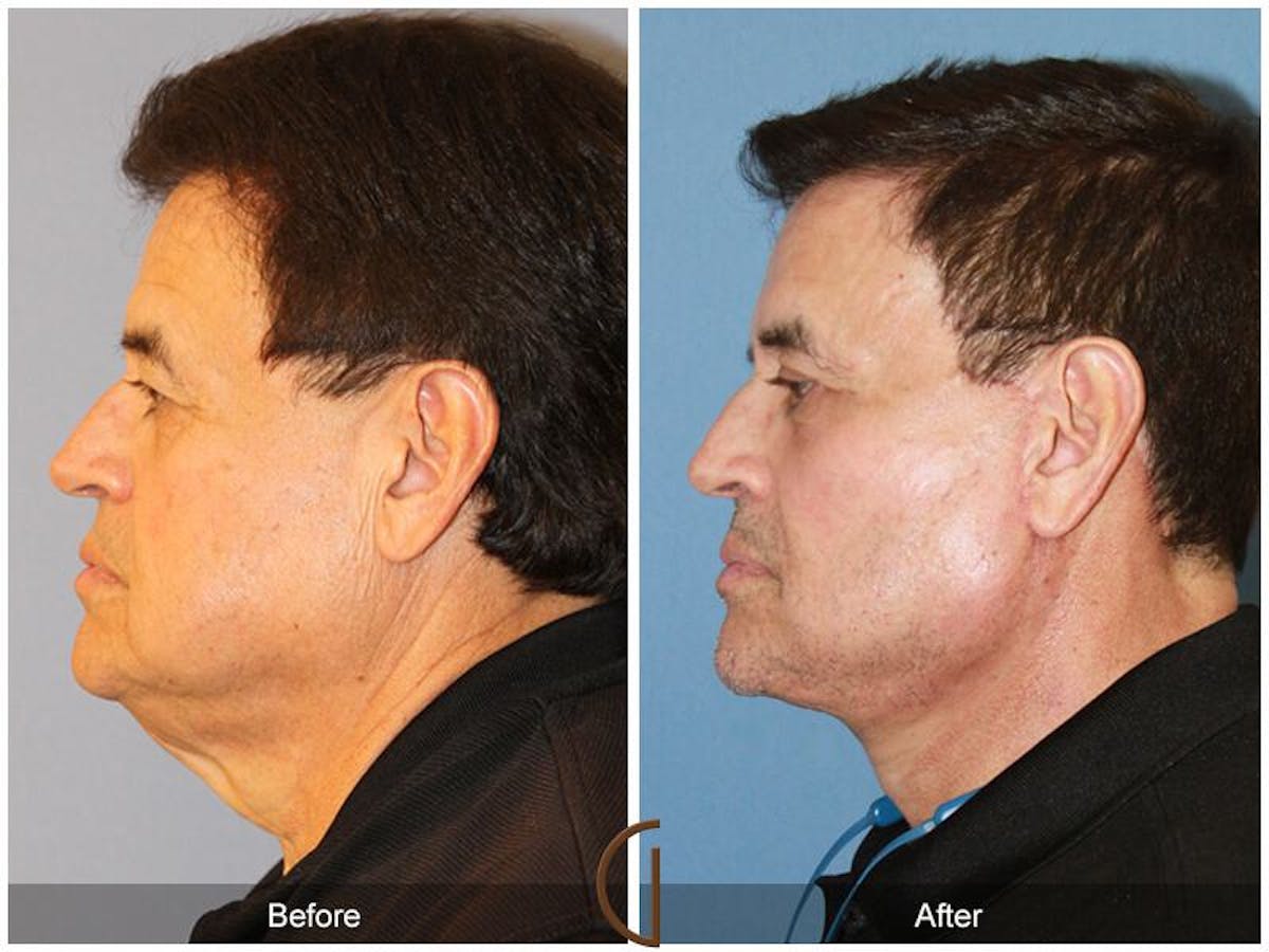 Facelift Male Before & After Gallery - Patient 304037 - Image 2