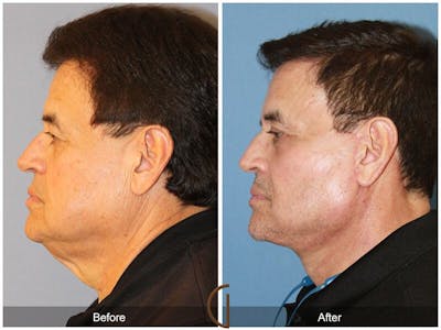 Neck Lift Before & After Gallery - Patient 247667 - Image 1