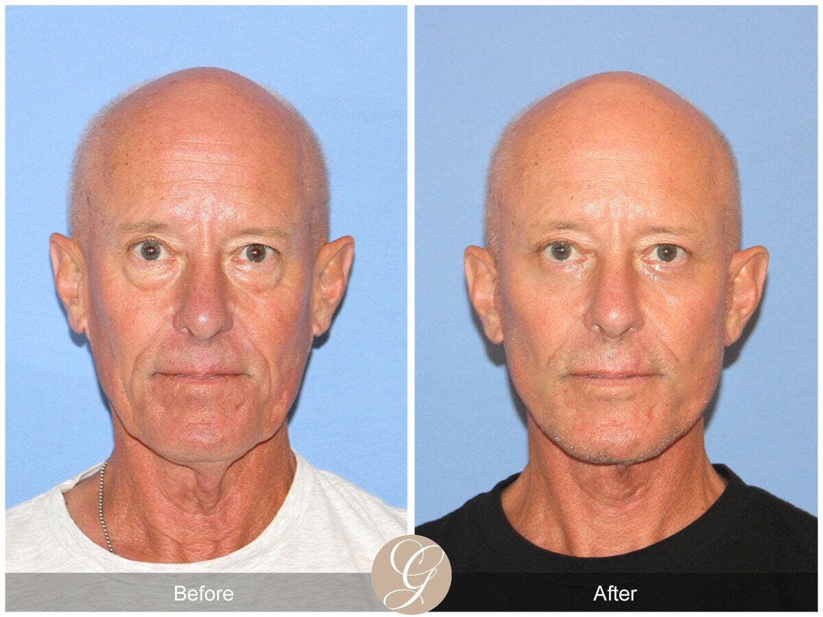 Facelift Male Before & After Gallery - Patient 271490 - Image 1