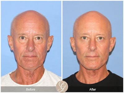 Facelift Male Before & After Gallery - Patient 271490 - Image 1