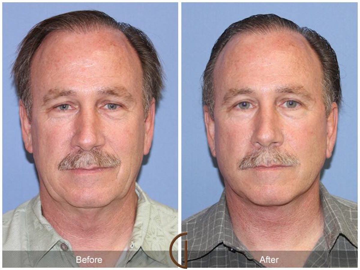 Facelift Male Before & After Gallery - Patient 894115 - Image 1