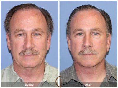 Facelift Male Before & After Gallery - Patient 894115 - Image 1