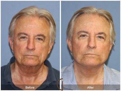 Facelift Male Before & After Gallery - Patient 544796 - Image 1