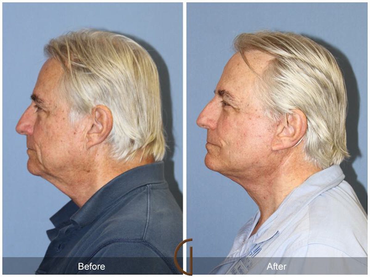 Facelift Male Before & After Gallery - Patient 544796 - Image 2