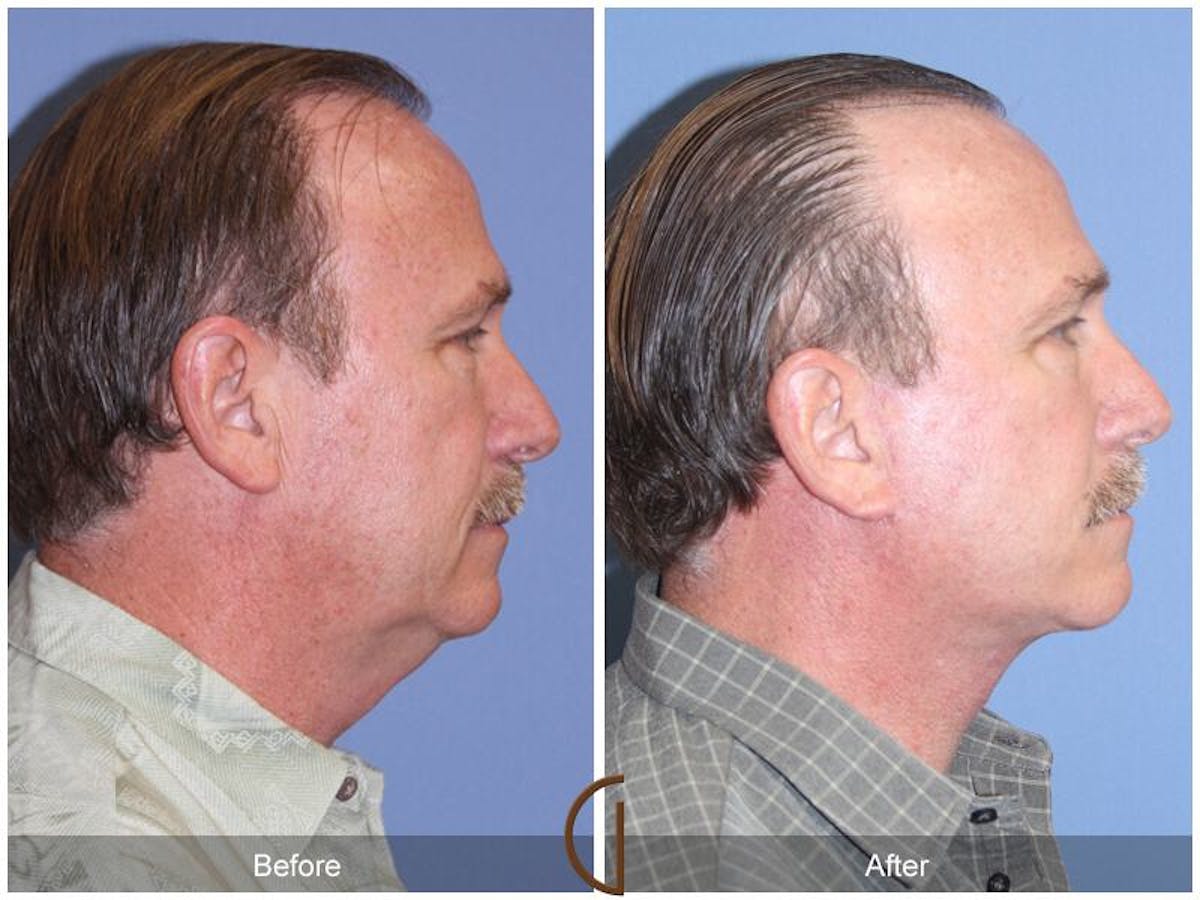Facelift Male Before & After Gallery - Patient 894115 - Image 3