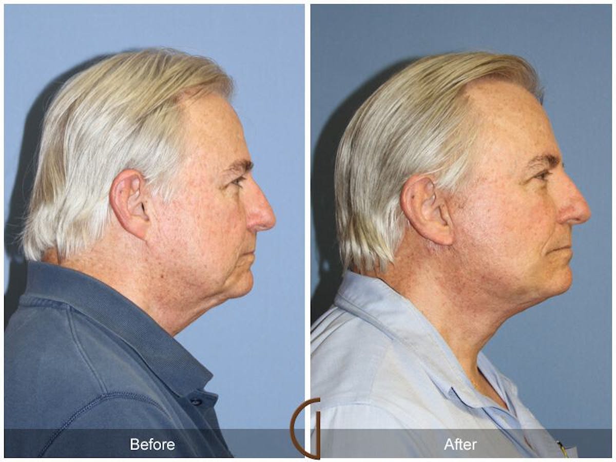Facelift Male Before & After Gallery - Patient 544796 - Image 3