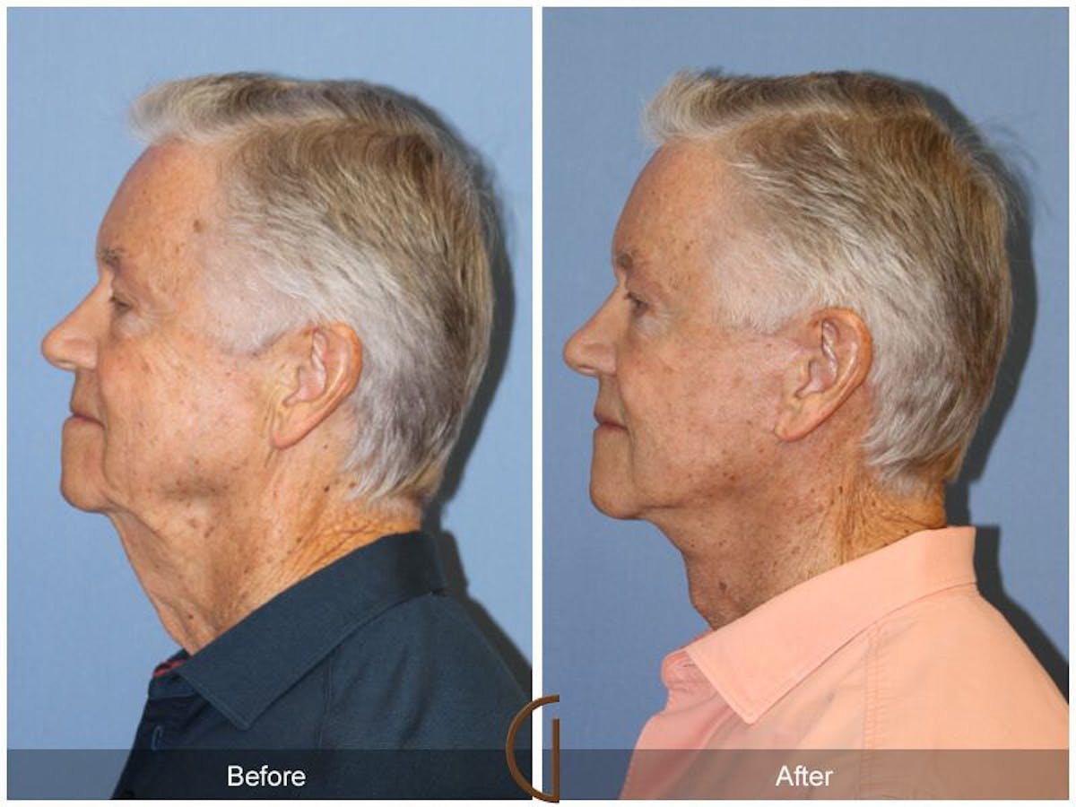 Facelift Male Before & After Gallery - Patient 979502 - Image 2