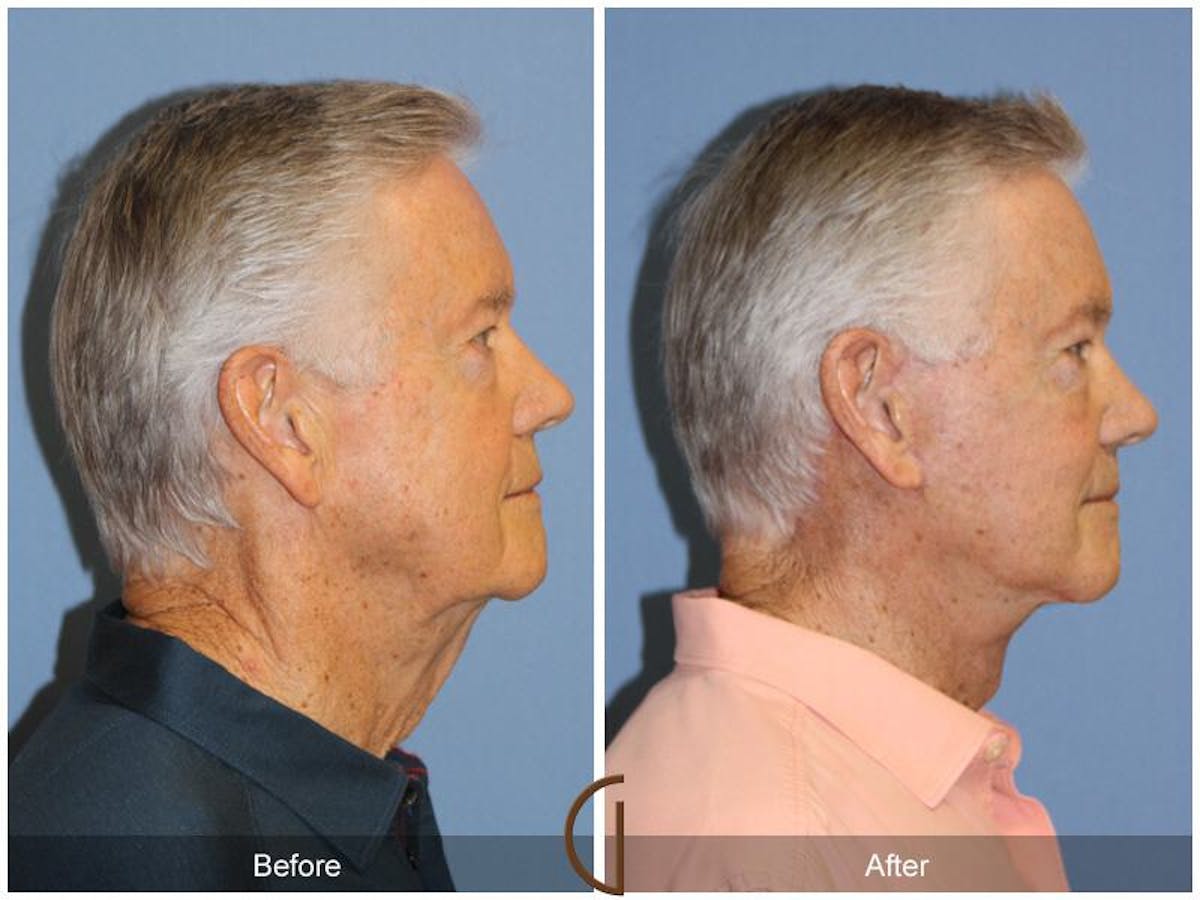 Facelift Male Before & After Gallery - Patient 979502 - Image 3