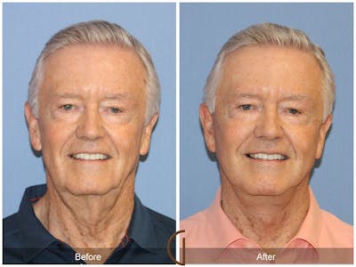 Facelift Male Before & After Gallery - Patient 979502 - Image 1