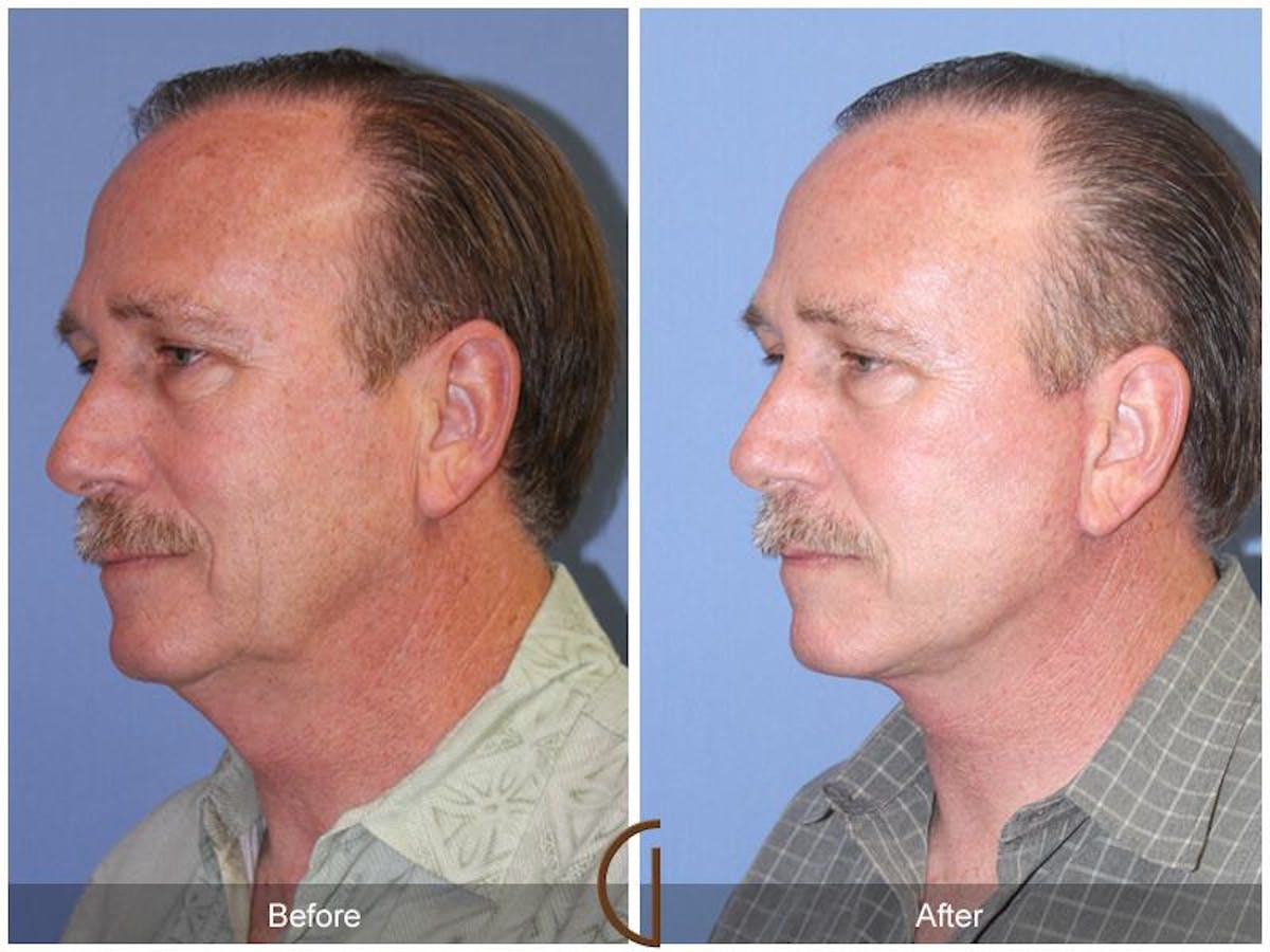 Facelift Male Before & After Gallery - Patient 894115 - Image 2