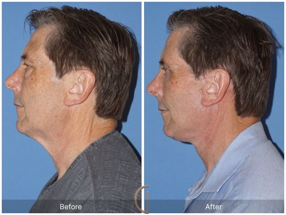 Facelift Male Before & After Gallery - Patient 413919 - Image 2