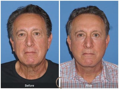 Facelift Male Before & After Gallery - Patient 158238 - Image 1
