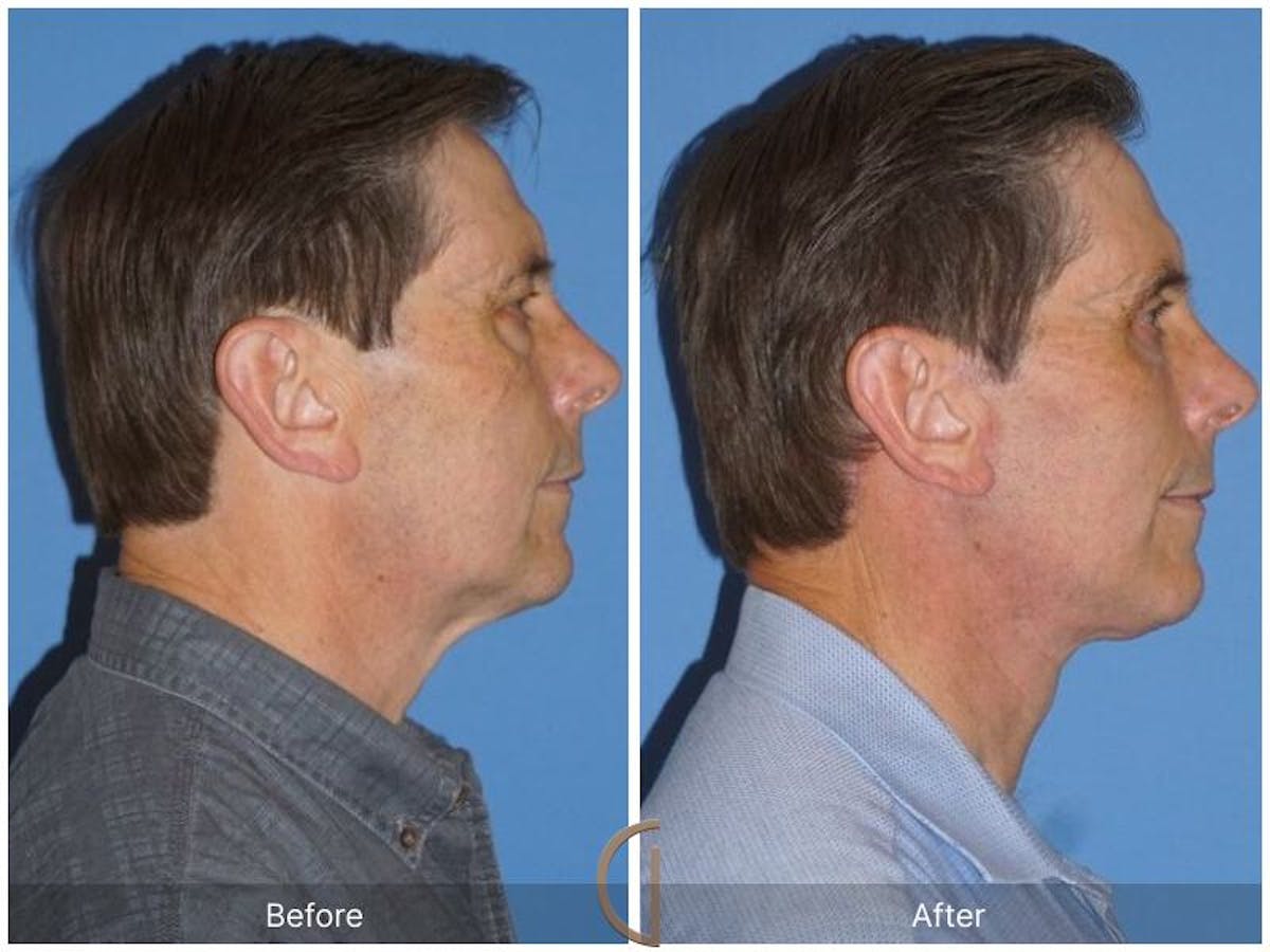 Facelift Male Before & After Gallery - Patient 413919 - Image 3