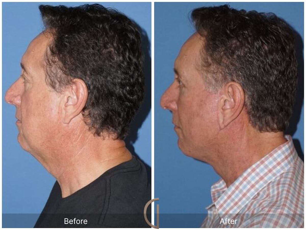 Facelift Male Before & After Gallery - Patient 158238 - Image 2
