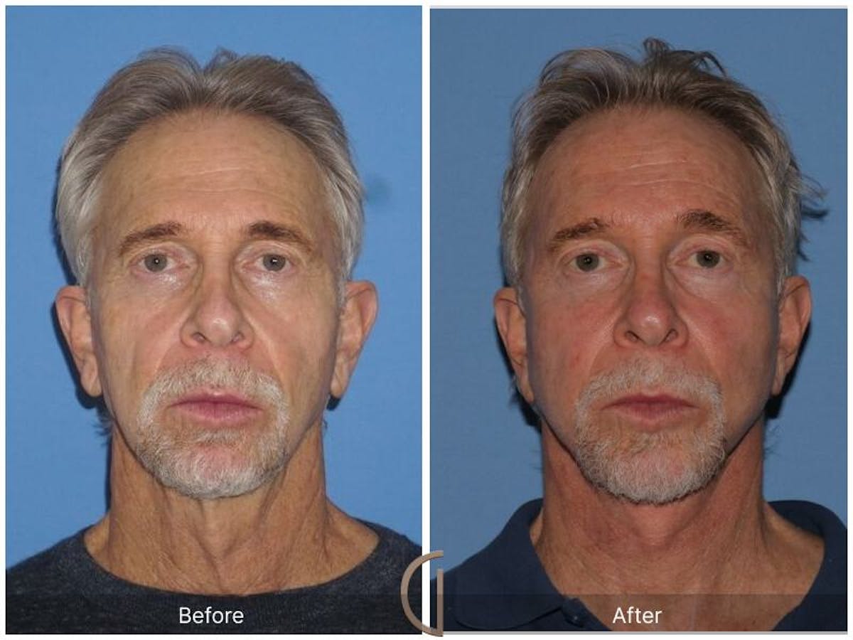 Facelift Male Before & After Gallery - Patient 250163 - Image 1