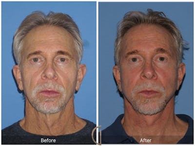 Facelift Male Before & After Gallery - Patient 250163 - Image 1