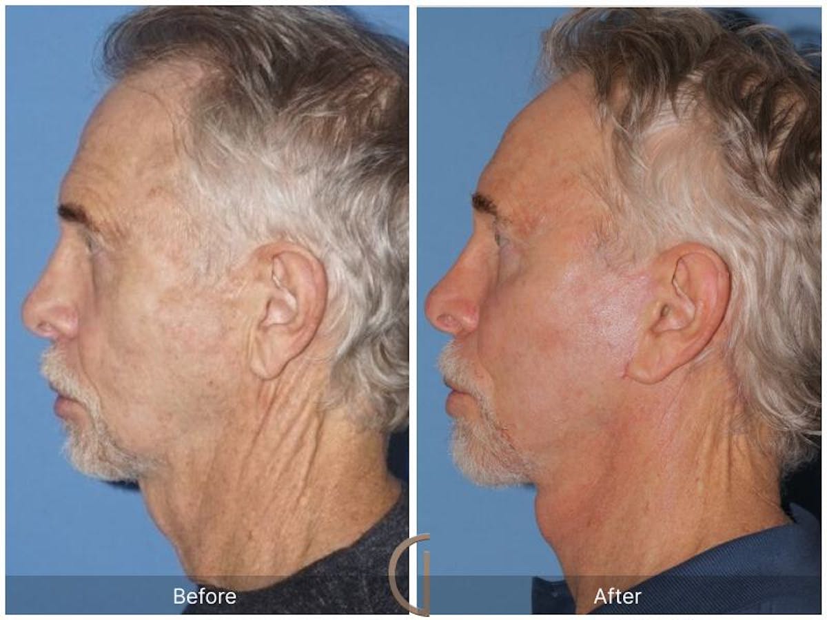 Facelift Male Before & After Gallery - Patient 250163 - Image 2