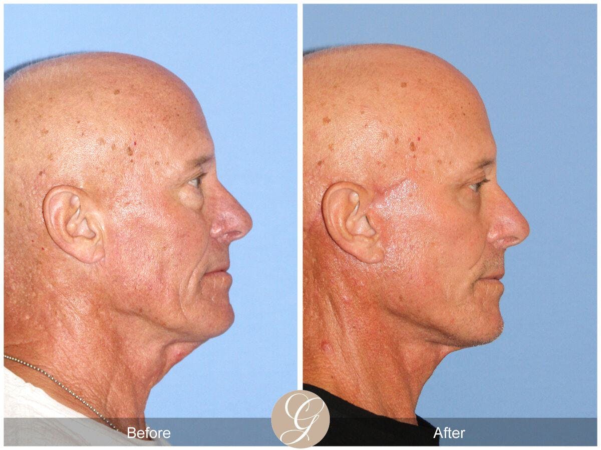 Facelift Male Before & After Gallery - Patient 271490 - Image 3