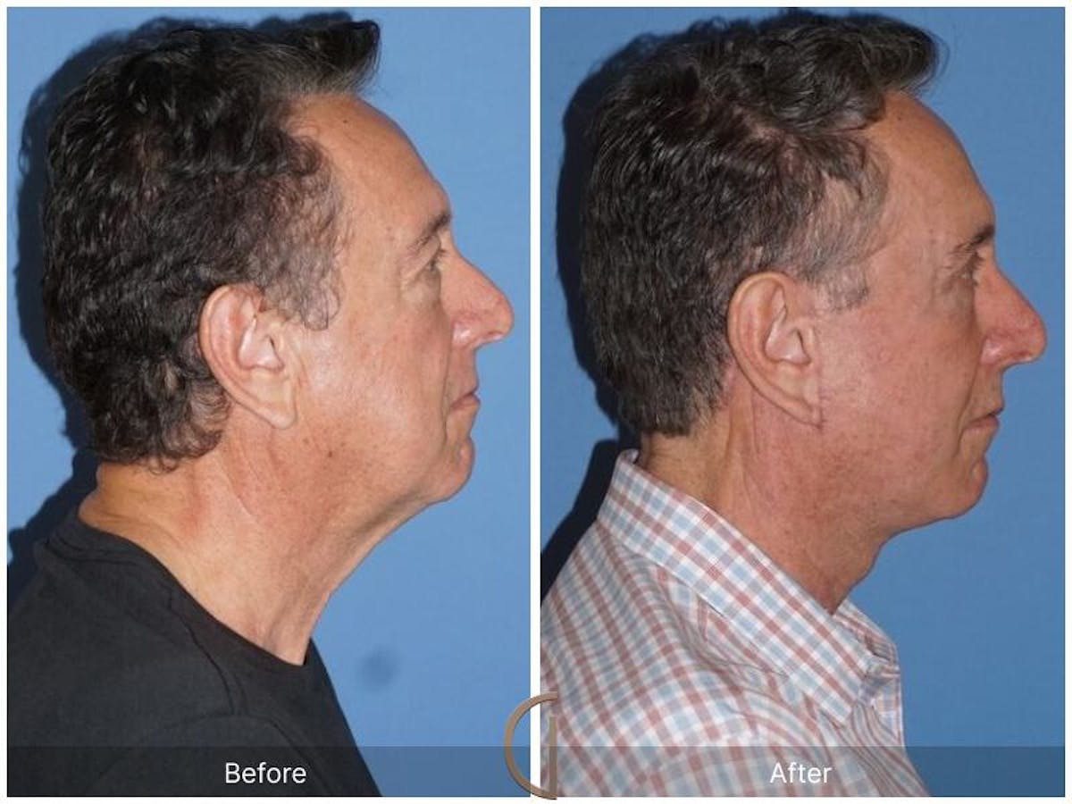 Facelift Male Before & After Gallery - Patient 158238 - Image 3