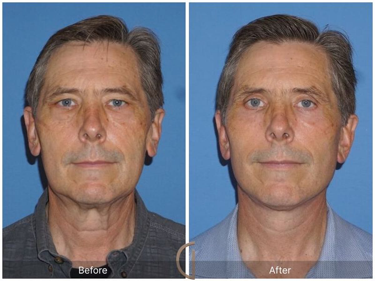 Facelift Male Before & After Gallery - Patient 413919 - Image 1