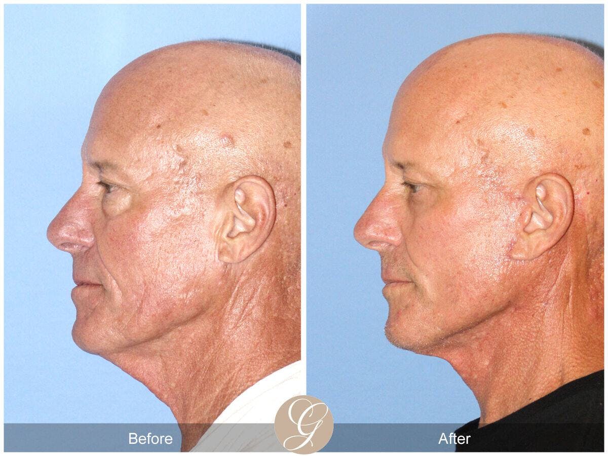 Facelift Male Before & After Gallery - Patient 271490 - Image 2