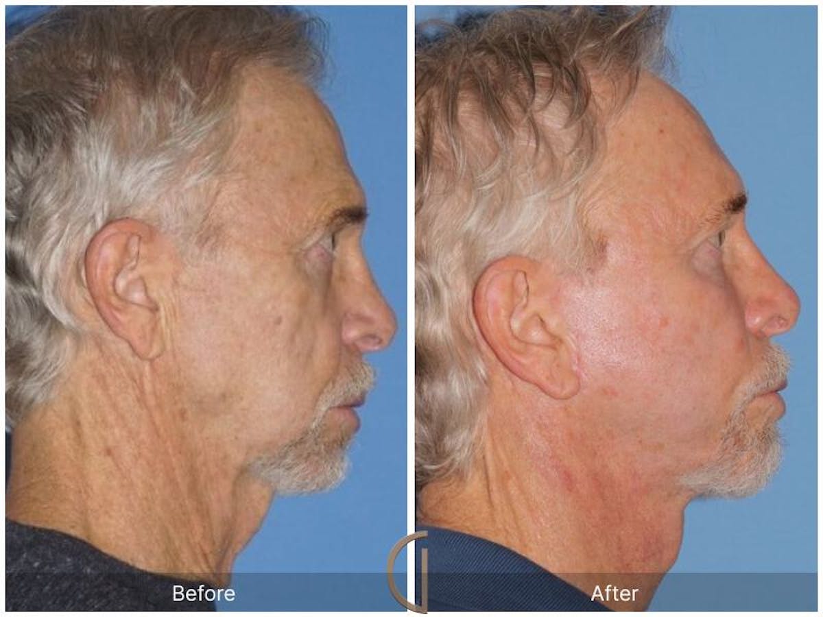 Facelift Male Before & After Gallery - Patient 250163 - Image 3