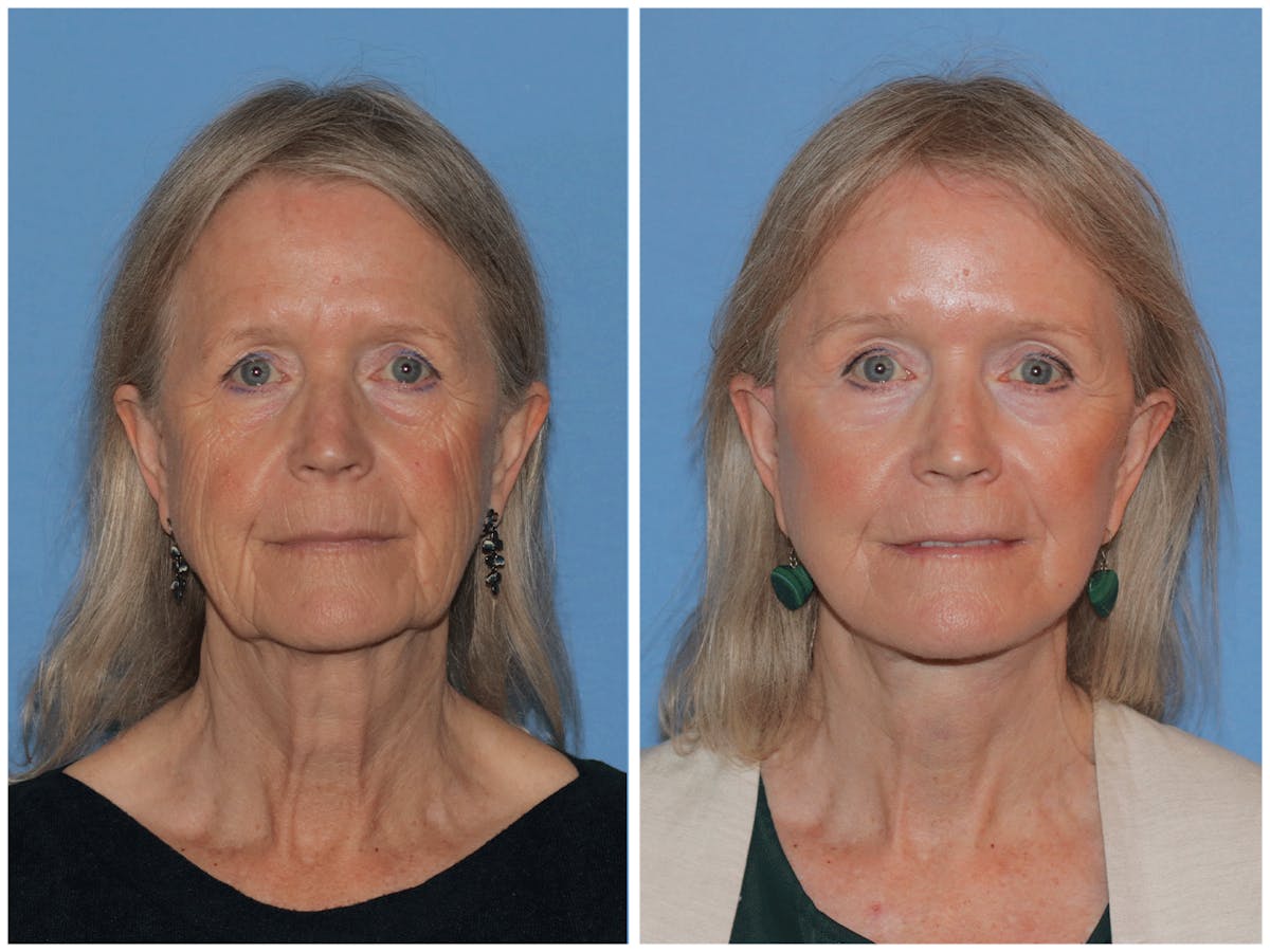 Preservation Facelift Before & After Gallery - Patient 243869 - Image 1