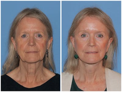 Preservation Facelift Before & After Gallery - Patient 243869 - Image 1