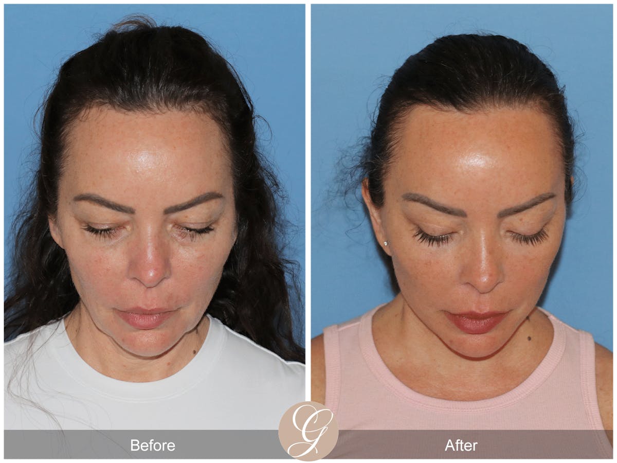 Preservation Facelift Before & After Gallery - Patient 315648 - Image 3