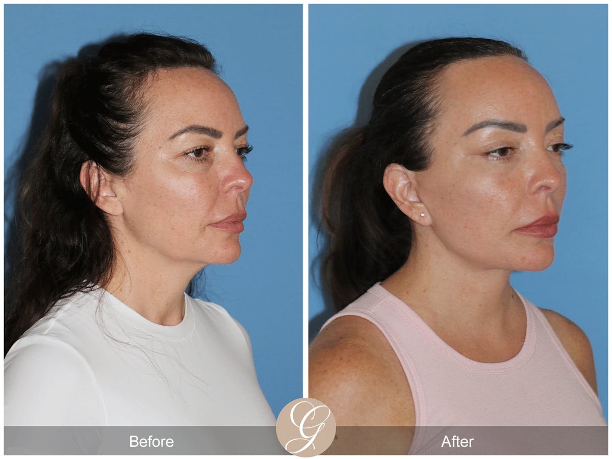 Preservation Facelift Before & After Gallery - Patient 315648 - Image 2