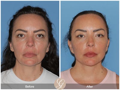 Deep Plane Facelift Before & After Gallery - Patient 714938 - Image 1