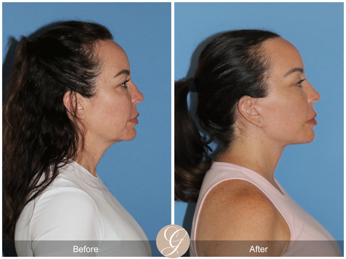 Preservation Facelift Before & After Gallery - Patient 315648 - Image 5