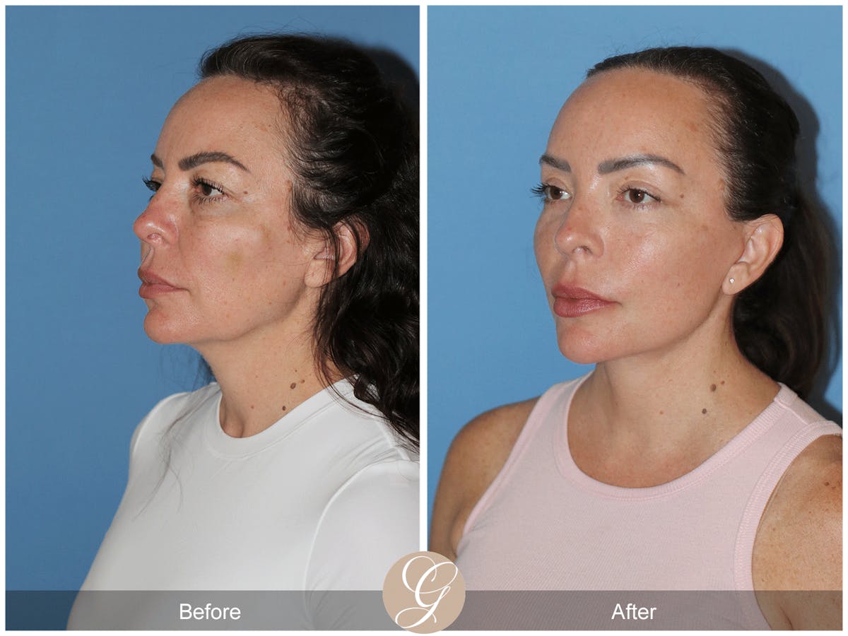 Preservation Facelift Before & After Gallery - Patient 315648 - Image 4