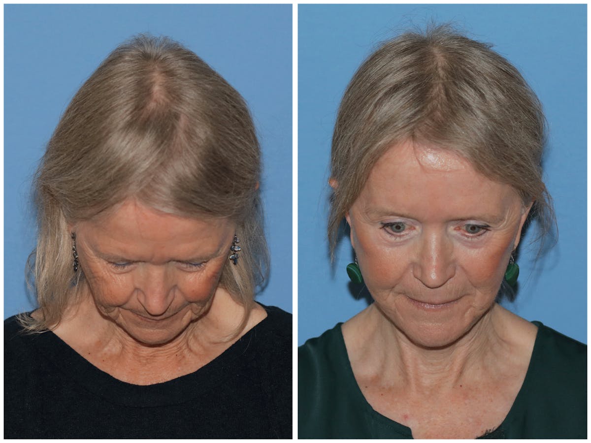 Preservation Facelift Before & After Gallery - Patient 243869 - Image 2