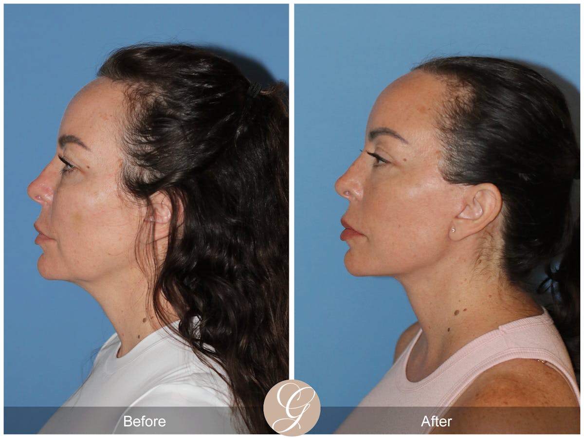 Preservation Facelift Before & After Gallery - Patient 315648 - Image 6