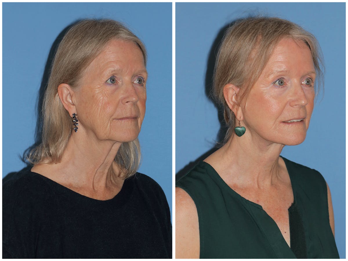 Preservation Facelift Before & After Gallery - Patient 243869 - Image 3