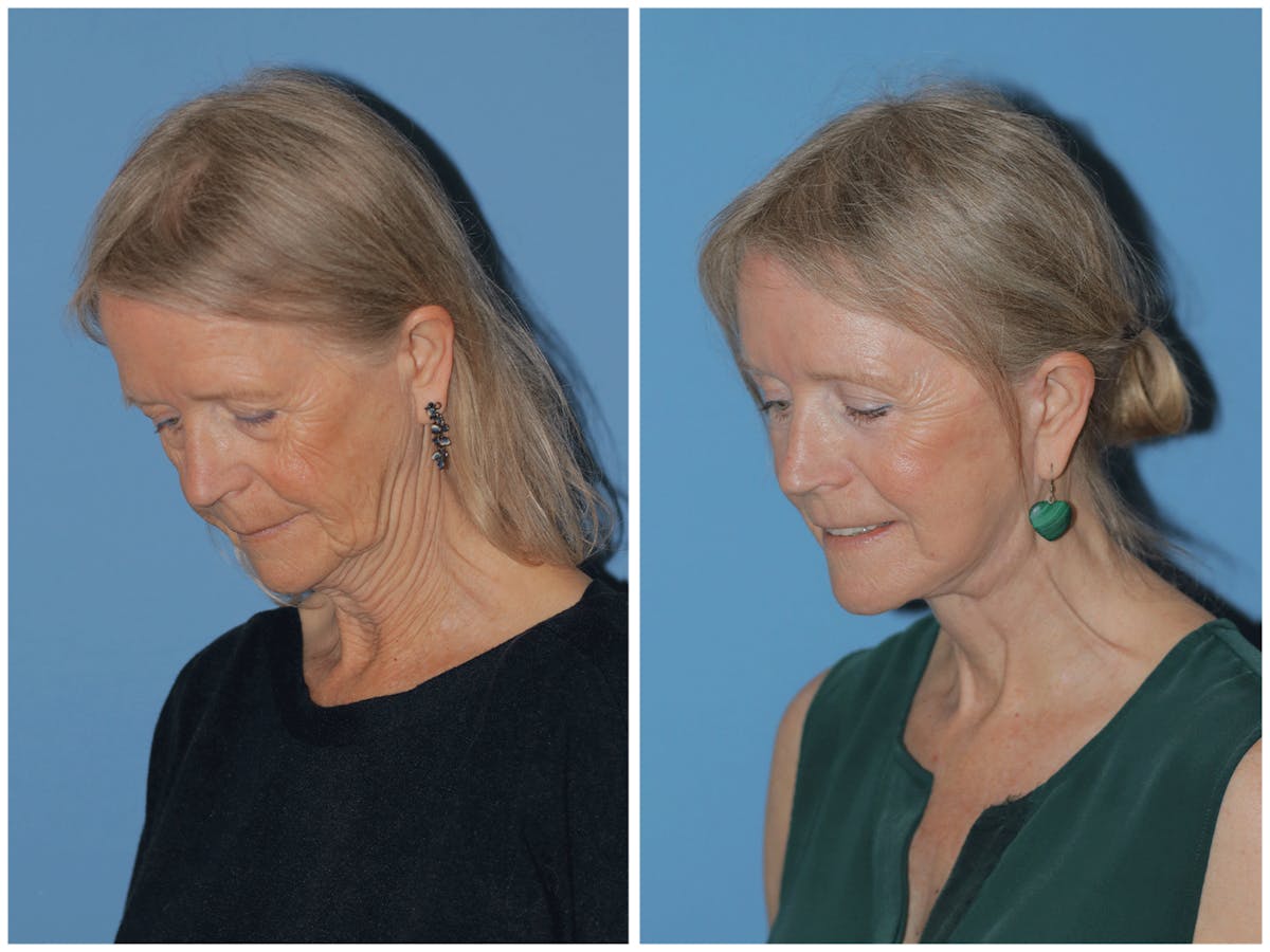 Preservation Facelift Before & After Gallery - Patient 243869 - Image 6