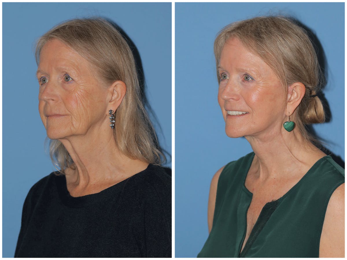 Preservation Facelift Before & After Gallery - Patient 243869 - Image 9
