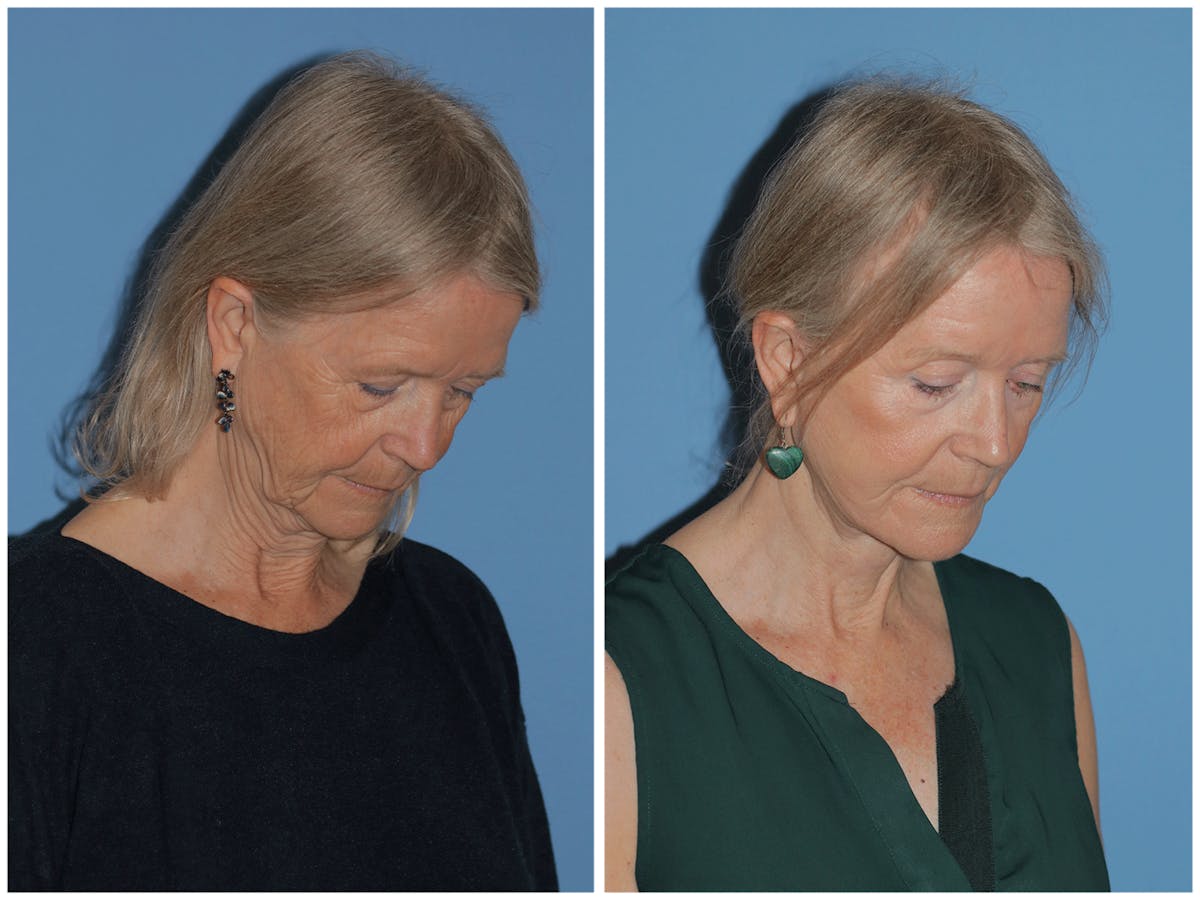 Preservation Facelift Before & After Gallery - Patient 243869 - Image 7