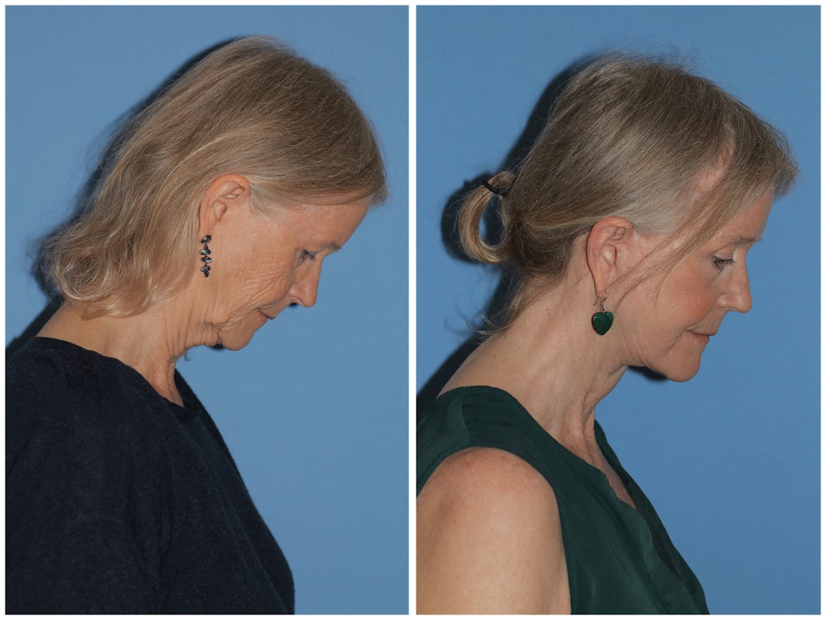 Preservation Facelift Before & After Gallery - Patient 243869 - Image 4