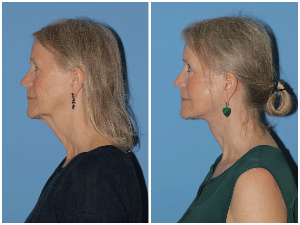 Preservation Facelift Before & After Gallery - Patient 243869 - Image 8