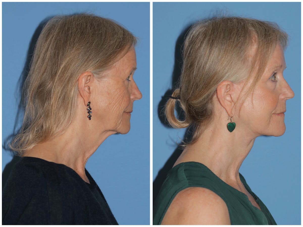 Preservation Facelift Before & After Gallery - Patient 243869 - Image 5